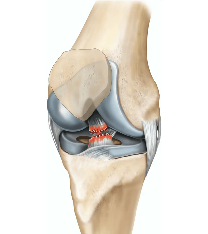 ACL reconstruction tendon graft illustration