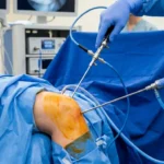 Knee Arthroscopy Recovery Time: Procedure, Healing Timeline & What to Expect