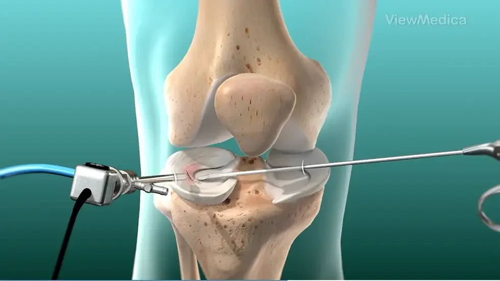Partial Meniscectomy