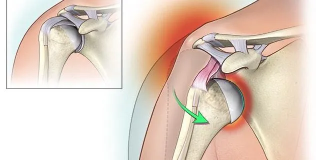 Posterior Shoulder Dislocation