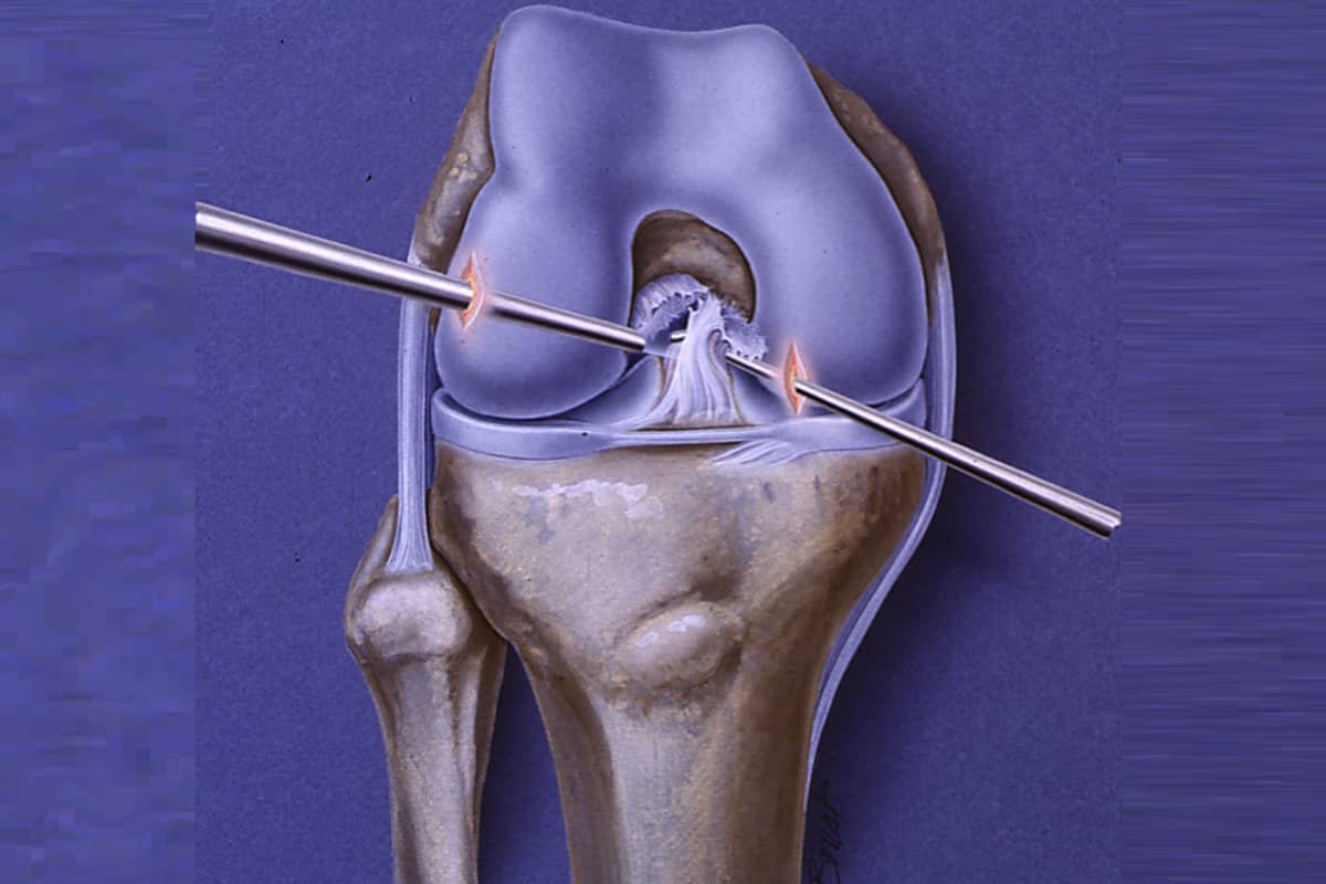 ACL Joint Progression