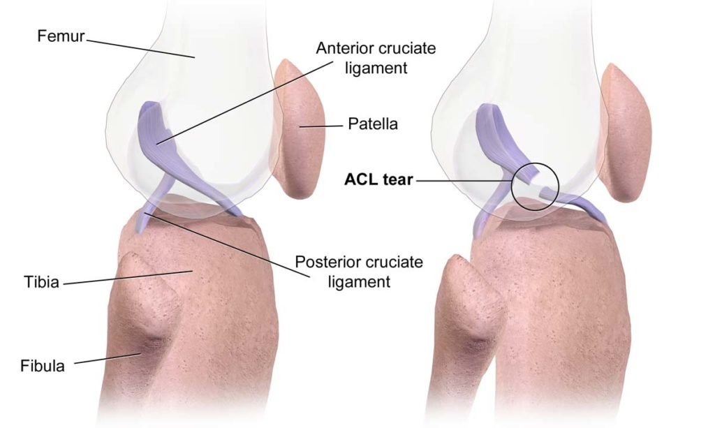 ACL Tear Diagnostics