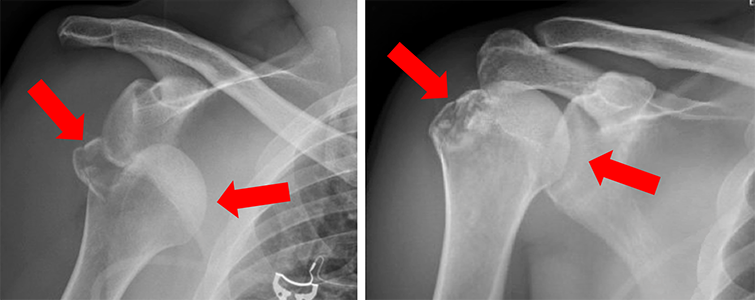 Inferior Shoulder Dislocation