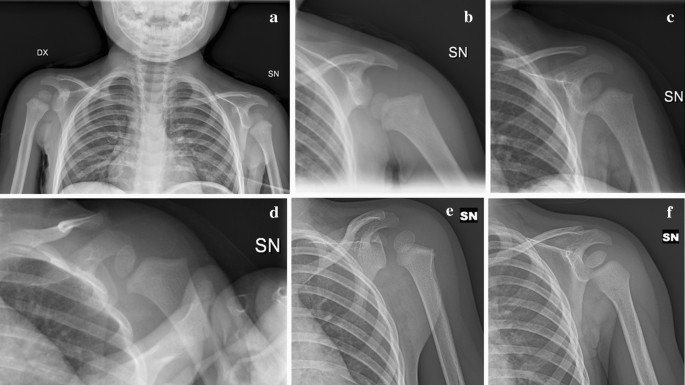 Anterior Shoulder Dislocation