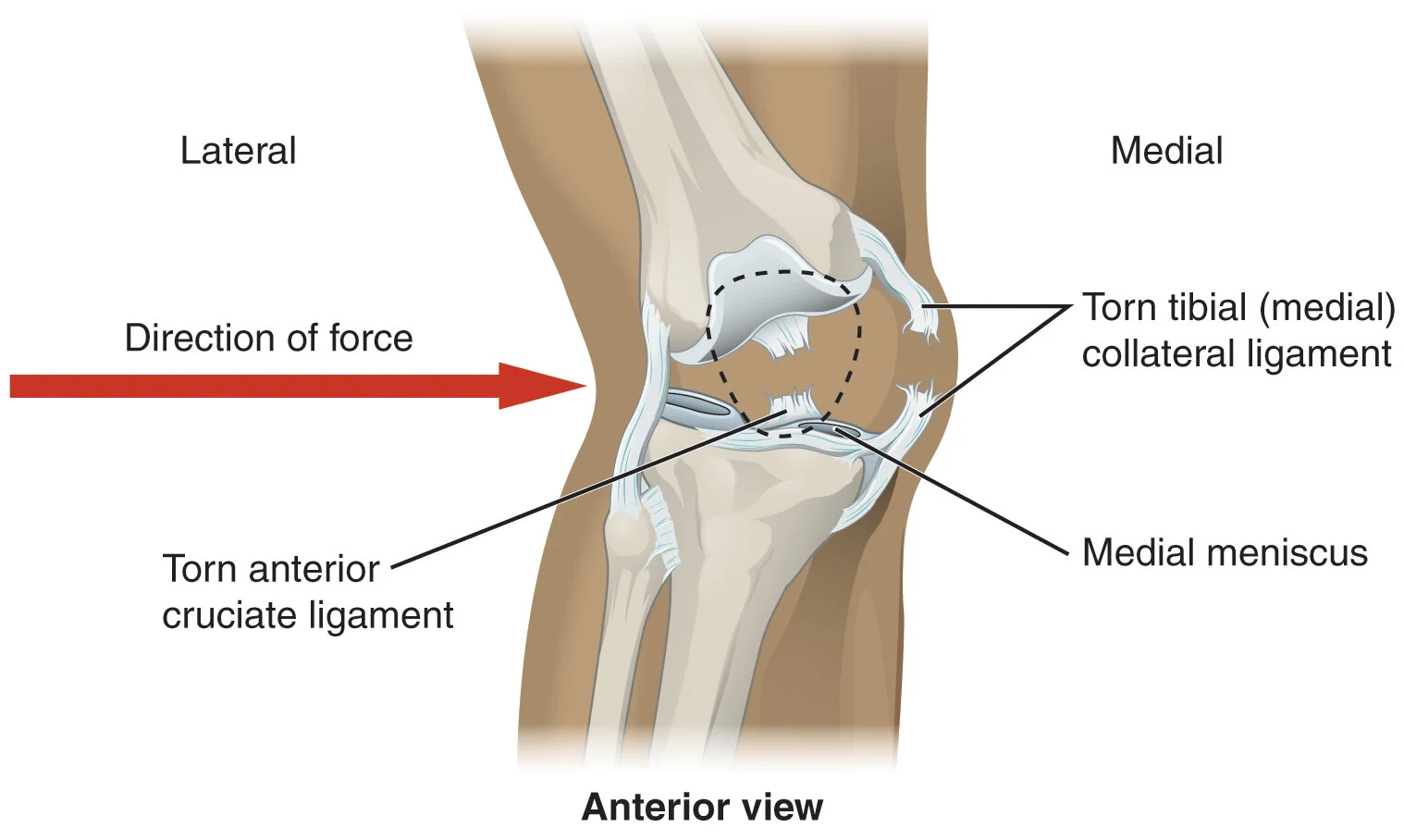 Ligament injury medical visual 2