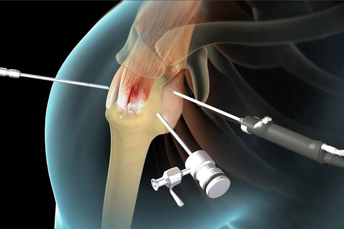 Rotator cuff surgery