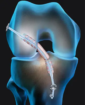 Advanced Joint Recovery