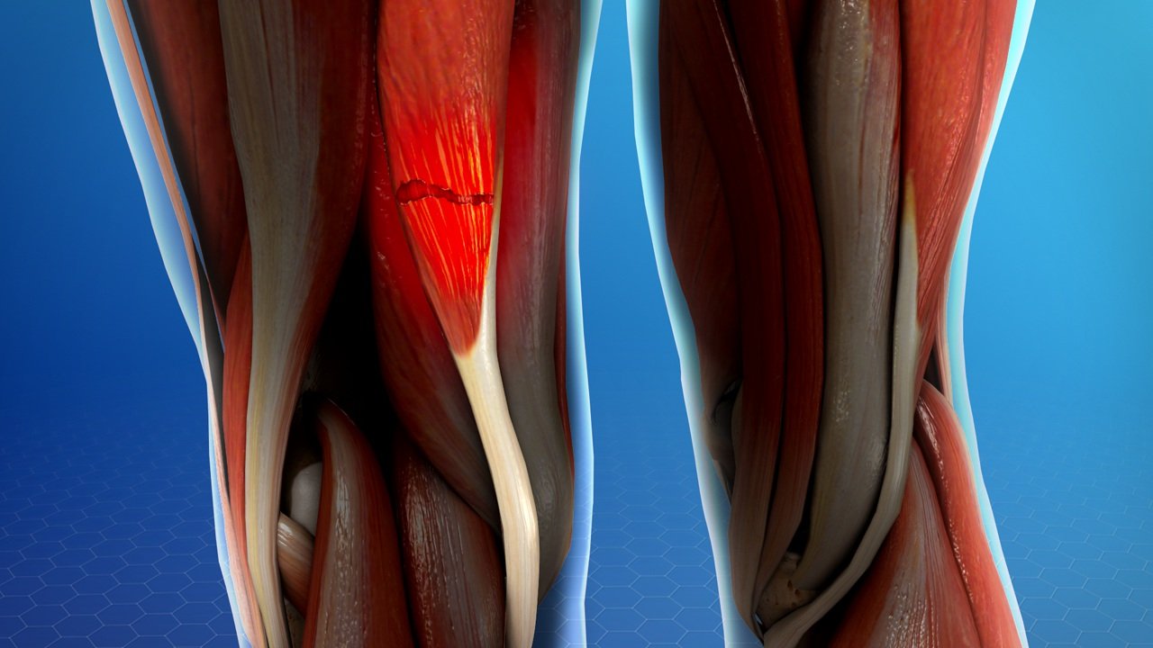 Muscle Injuries